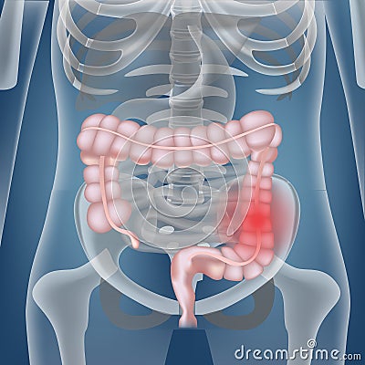 Bowel cancer. The location of the internal organs against the background of the skeleton. Vector Illustration